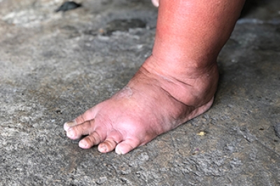 The Connection Between Swollen Feet and Diabetes