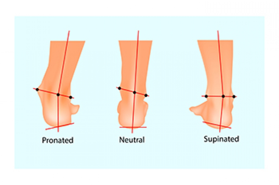 Foot Supination: Diagnosis, Causes, and Treatment - Custom