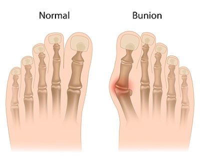 Bunion Treatment