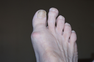 What Is Morton’s Toe?