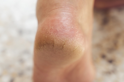 Cracked Heels and Their Effects